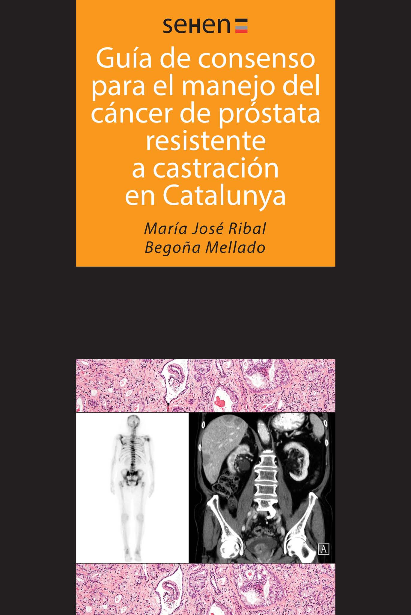 GuÃ­as de consenso para el manejo del cÃ¡ncer de prÃ³stata resistente a castraciÃ³n en Catalunya